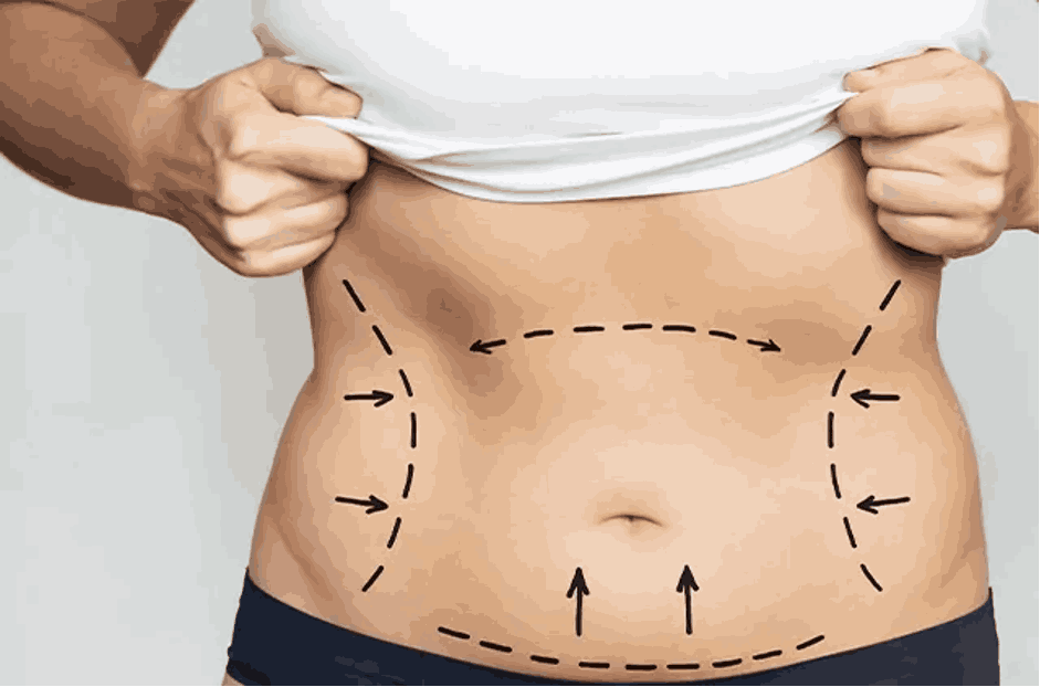 Bangalore Liposuction: What To Expect From A Famous Dermatologist In Bangalore
